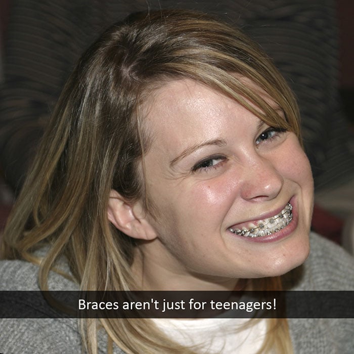 adult-braces